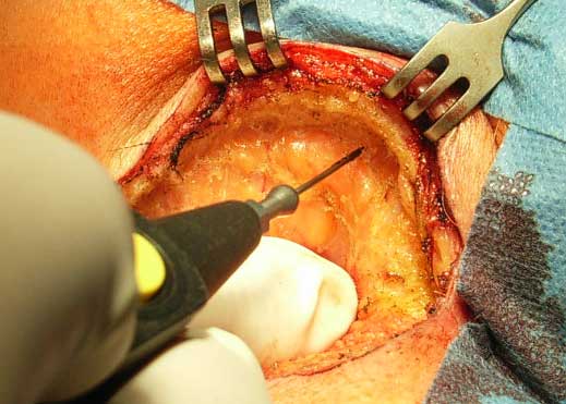 Operation eines sinus pilonidalis mit der Karydakis Methode. 