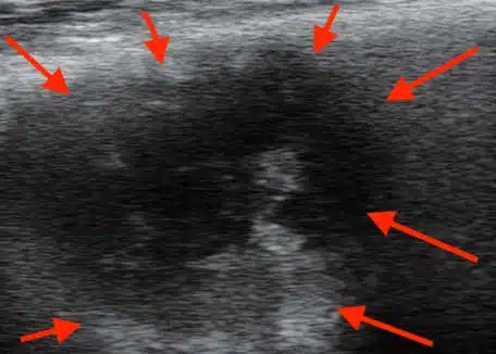 6 cm abscess ultrasound image