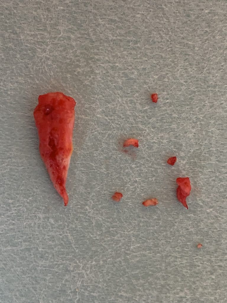 Fistula removed during pit picking surgery