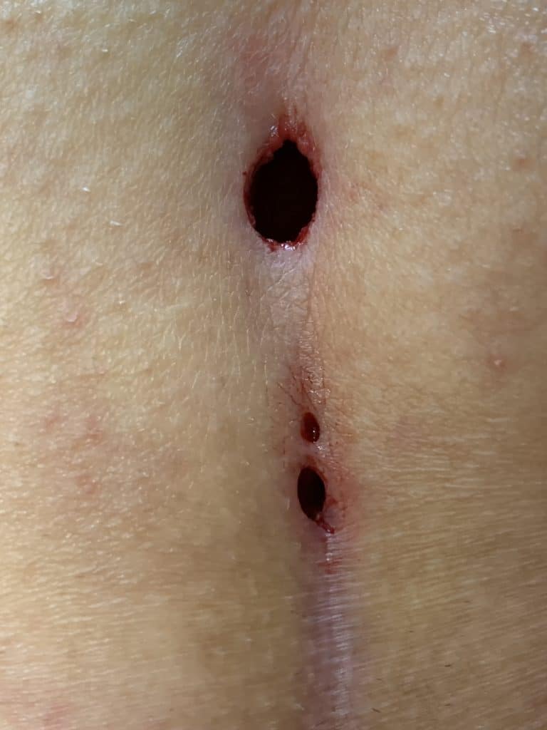 Picture of the course of treatment Situation after pit picking and sinusectomy