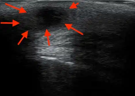 Pilonidal abscess2 Ultrasound image