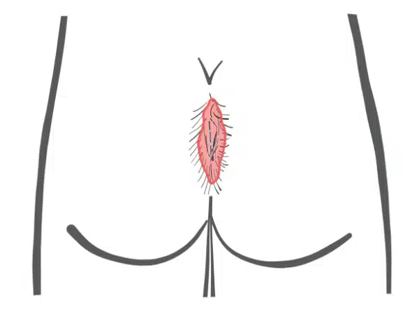 Schematic drawing Pilonidal Sinus Type IV B