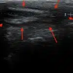 Type I B Pilonidal Sinus in ultrasound