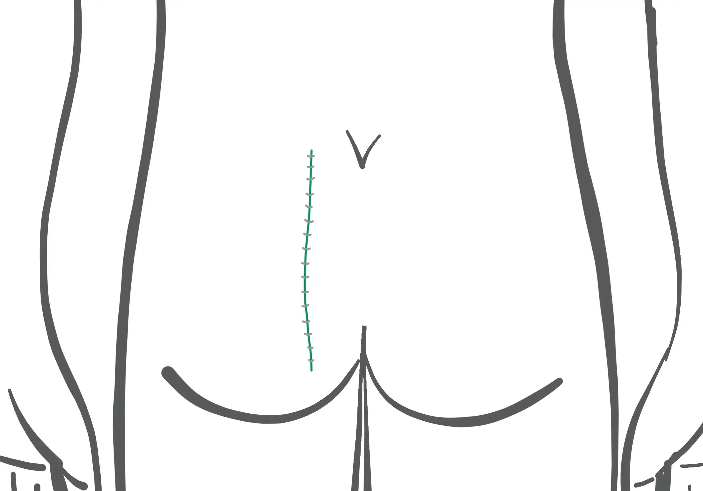 الرسم التخطيطي لجراحة كاريداكيس في نهاية العملية