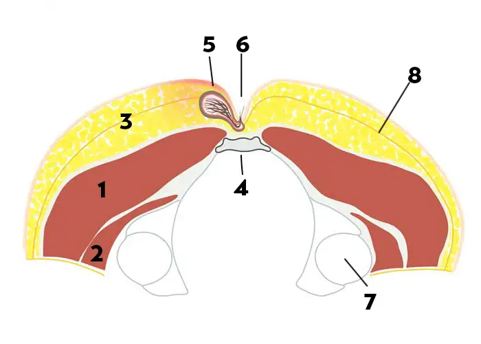 Schéma d'un sinus pilonidalis en coupe axiale