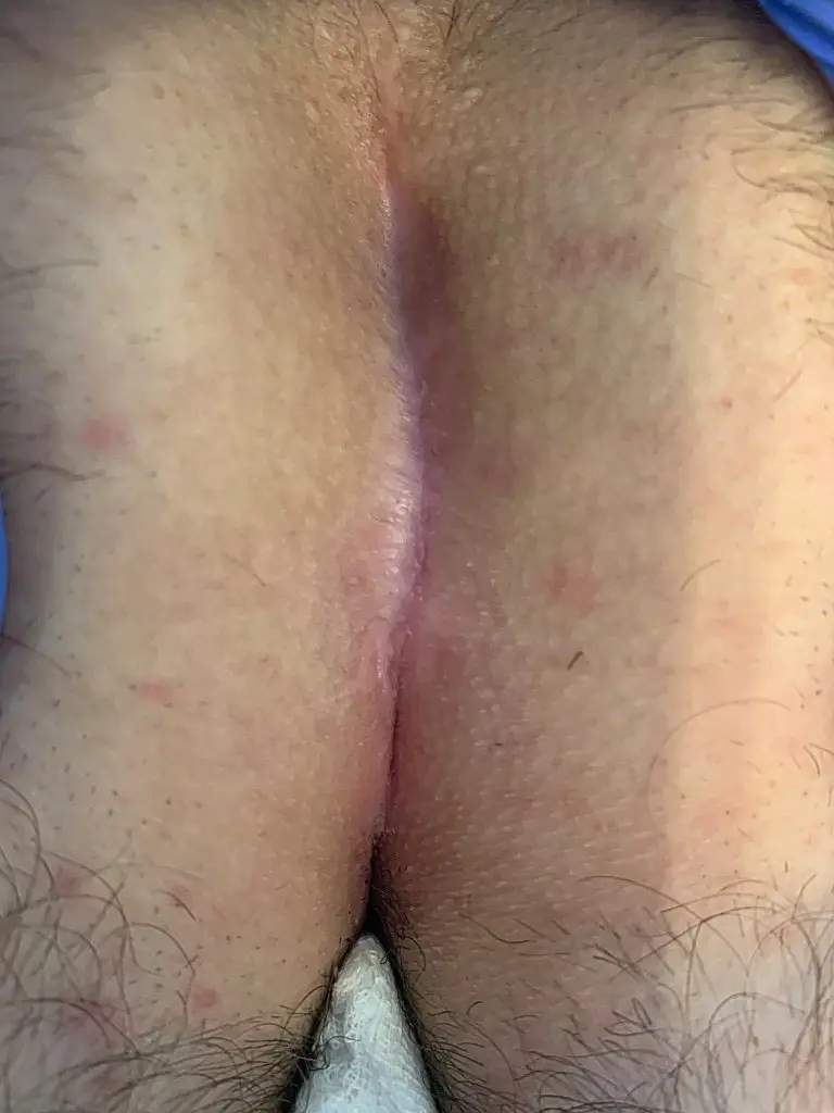 Completion of wound healing after laser OP