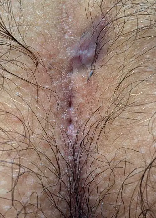 Type I A Fistula with 2 pits and secondary opening (&quot;pimples&quot;) right