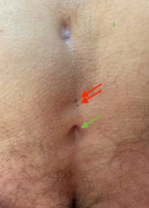 Type III Pilonidal Sinus with two additional pits