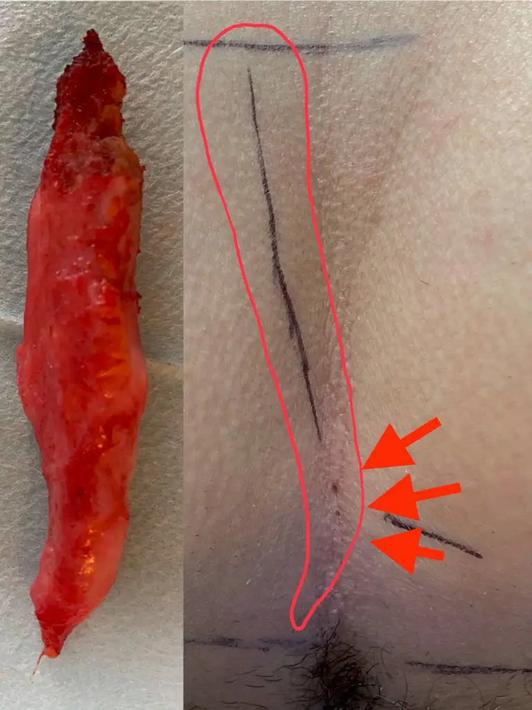 Long type I B fistula, 3 pits, the removed fistula on the left