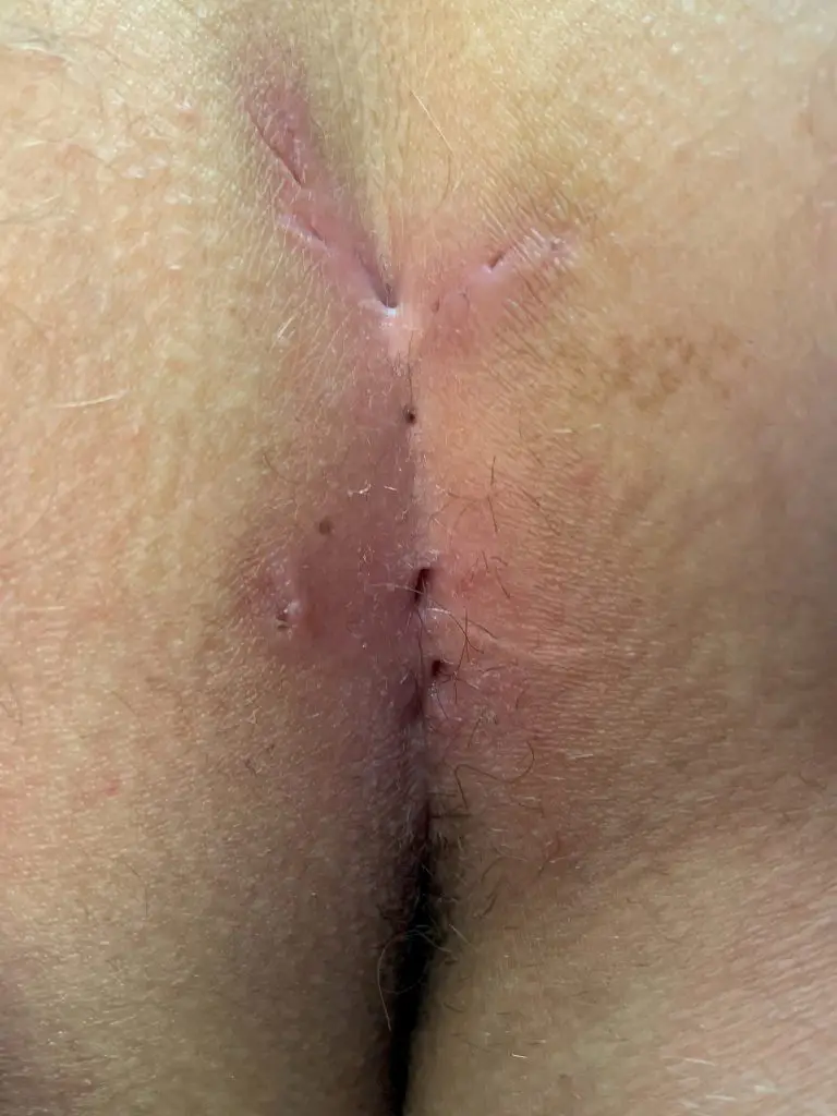 Mixed form of a pilonidal sinus with acne inversa