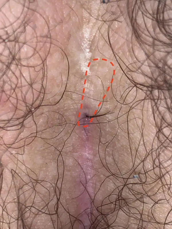 Type I A Fistula with prominent tuft of hair