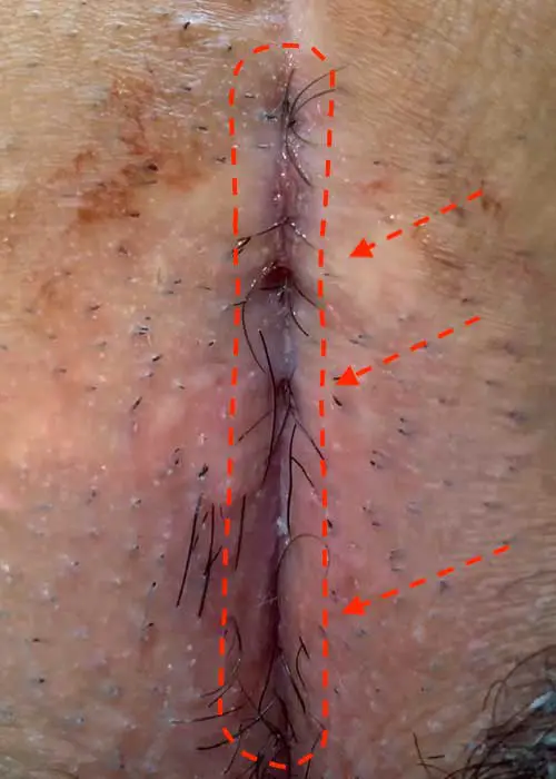 Typ IV B Steißbeinfistel, mehrere Eintrittspforten für Haare in der alten Narbe