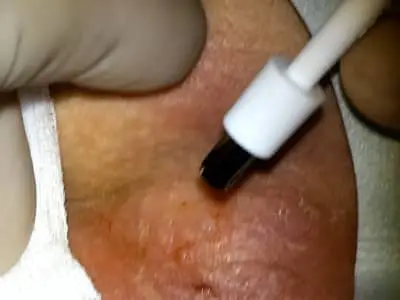 Biopsy punch for puncture of coccyx abscess