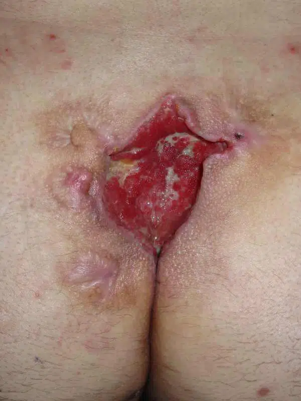 Squamous cell carcinoma of the rima ani