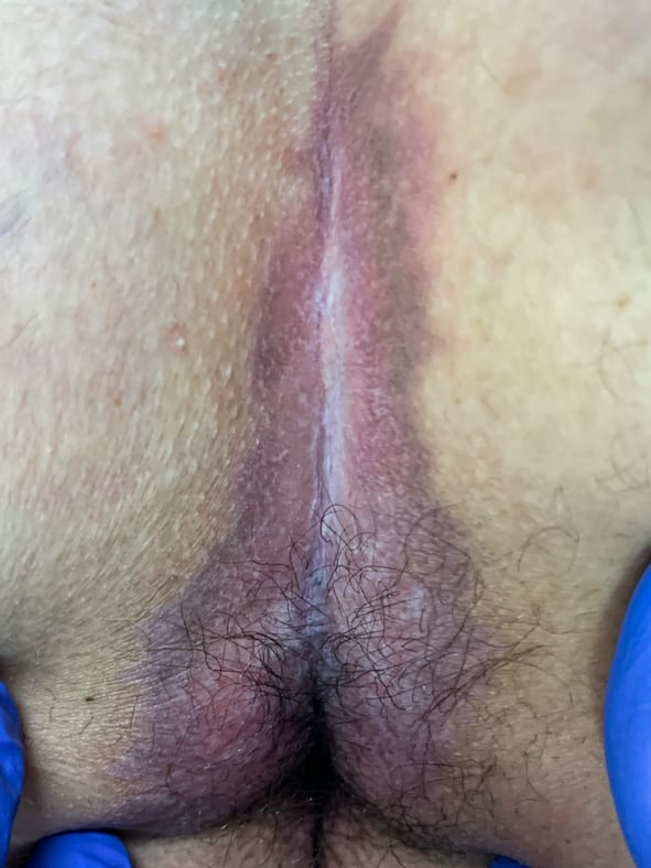 Differenzialdiagnose zur Steißbeinfistel bei Juckreiz
