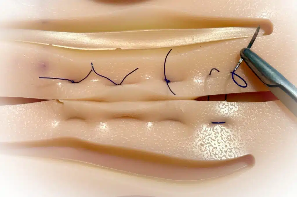 Bulging suture technique to prevent the suture from reopening after Pilonidal Sinus surgery.