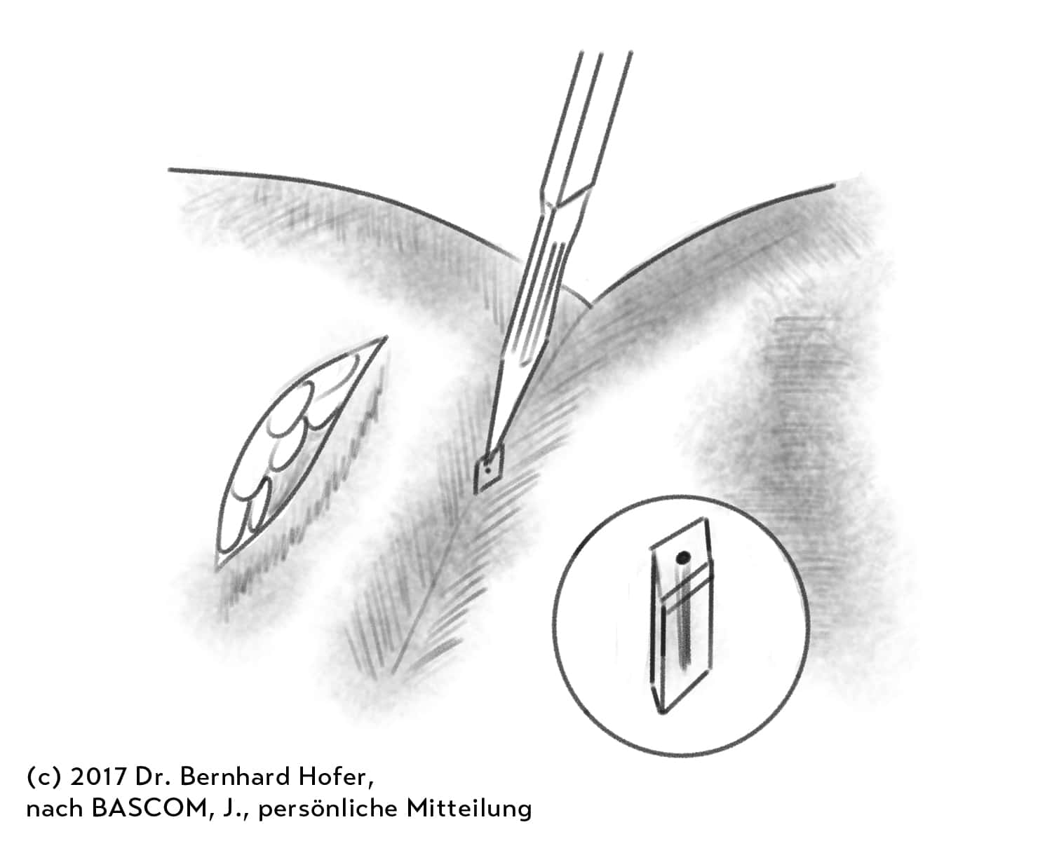 OP - Technik: Pit Picking - Pilonidal Sinus Zentrum