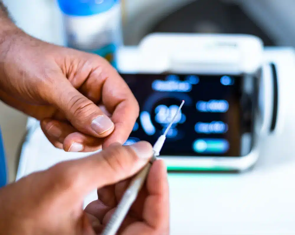 Diodenlaser zur Sinus pilonidalis OP